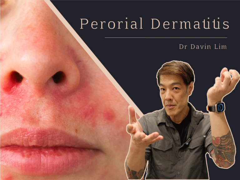 Effective Perioral Dermatitis Treatments Brisbane Cutis Dermatology