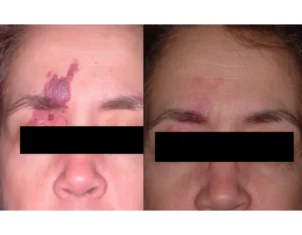 Birthmarks Treatment Cutis Dermatology Brisbane 10