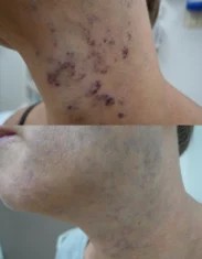 Birthmarks Treatment Cutis Dermatology Brisbane 4