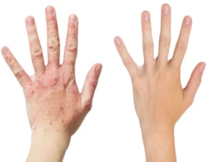 Eczema Treatment Cutis Dermatology Brisbane 3