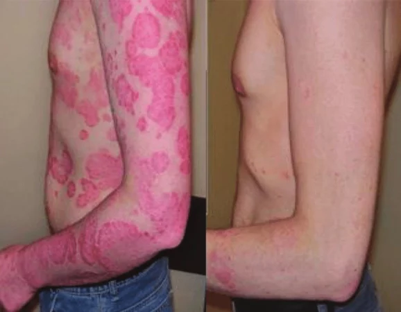 Phototherapy Treatment Cutis Dermatology Brisbane 3