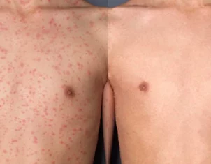 Pityriasis rosea Treatment Cutis Dermatology Brisbane 1