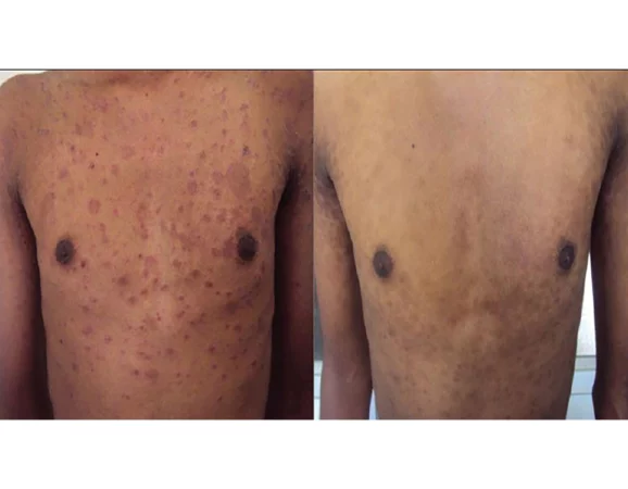 Pityriasis rosea Treatment Cutis Dermatology Brisbane 2