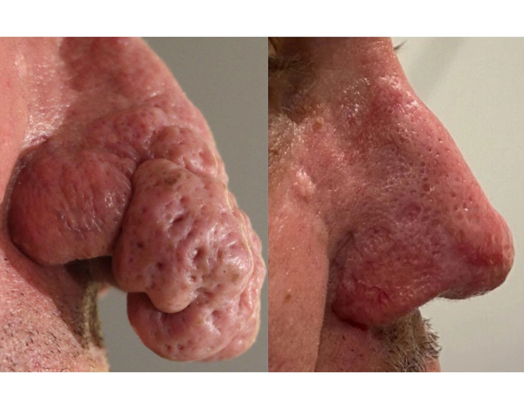 Rosacea Treatment Cutis Dermatology Brisbane 6