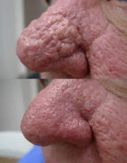 Rosacea Treatment Cutis Dermatology Brisbane 7