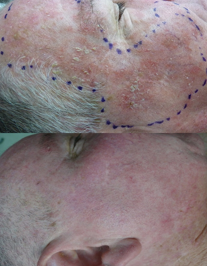 Skin Cancer Treatment Cutis Dermatology Brisbane 1