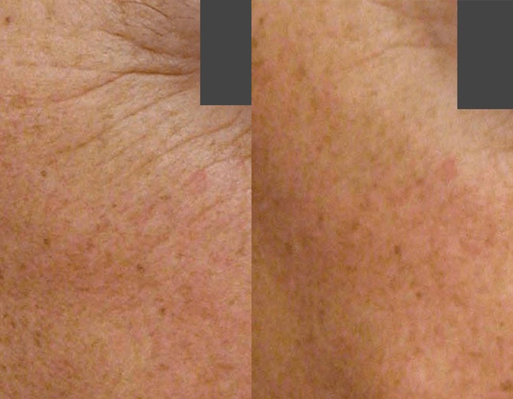 Skin Cancer Treatment Cutis Dermatology Brisbane 10
