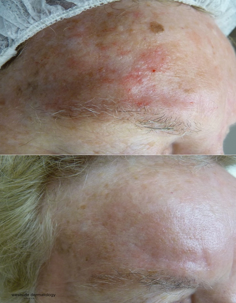 Skin Cancer Treatment Cutis Dermatology Brisbane 2