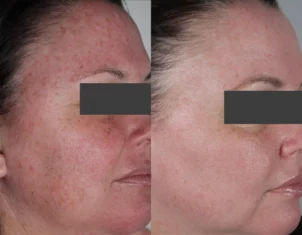 Skin Cancer Treatment Cutis Dermatology Brisbane 26