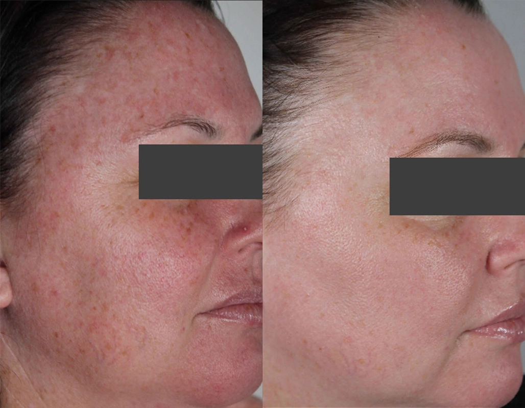 Skin Cancer Treatment Cutis Dermatology Brisbane 29