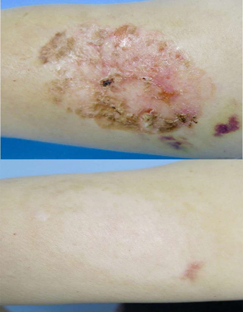 Skin Cancer Treatment Cutis Dermatology Brisbane 3