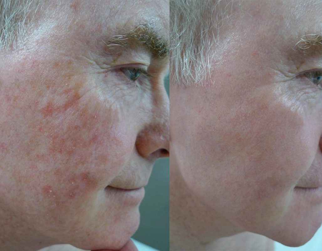 Skin Cancer Treatment Cutis Dermatology Brisbane 30