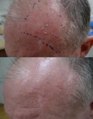 Skin Cancer Treatment Cutis Dermatology Brisbane 31