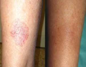 Skin Cancer Treatment Cutis Dermatology Brisbane 4
