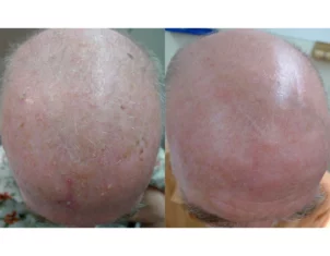 Skin Cancer Treatment Cutis Dermatology Brisbane 5