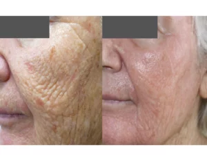 Skin Cancer Treatment Cutis Dermatology Brisbane 6