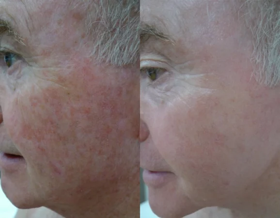 Skin Cancer Treatment Cutis Dermatology Brisbane 7