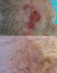 Skin Cancer Treatment Cutis Dermatology Brisbane 9