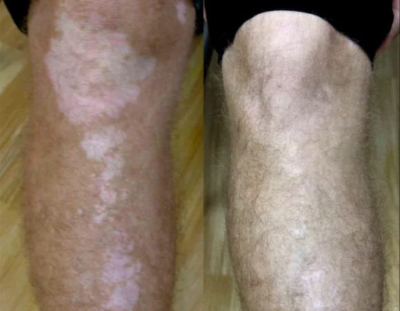 Vitiligo Treatment Cutis Dermatology Brisbane 11