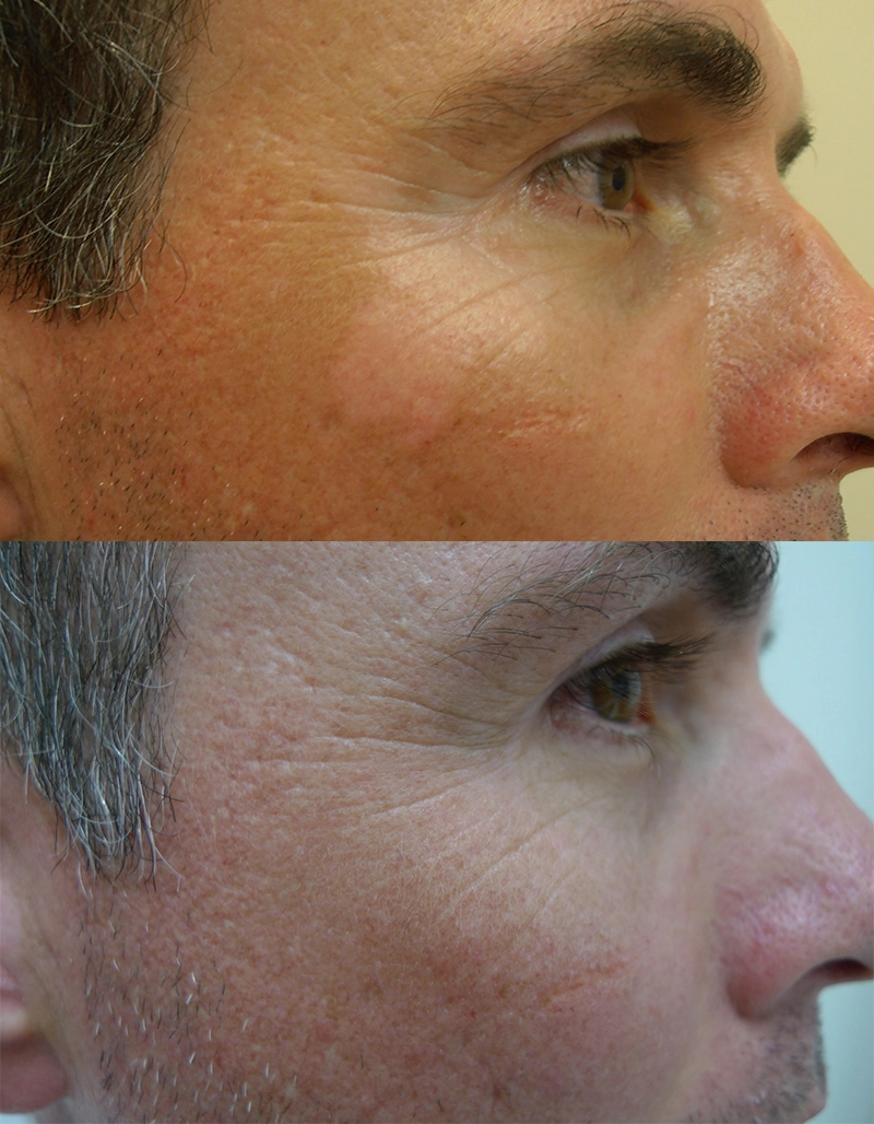 Vitiligo Treatment Cutis Dermatology Brisbane 12