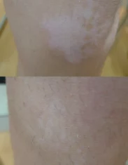 Vitiligo Treatment Cutis Dermatology Brisbane 13
