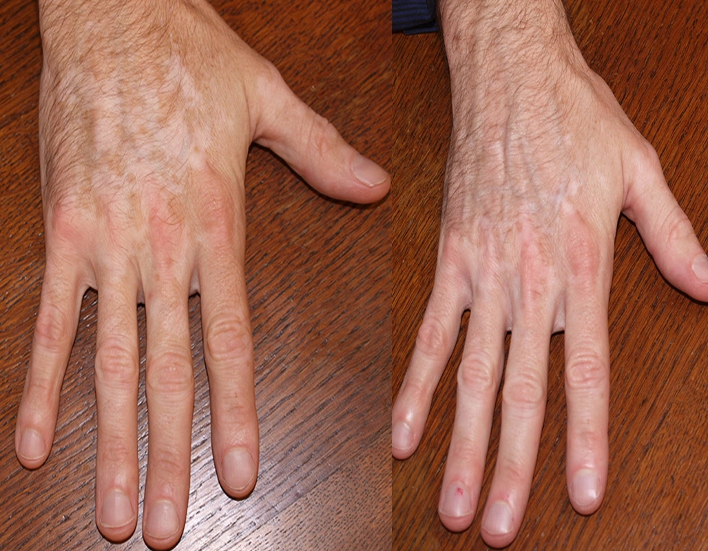 Vitiligo Treatment Cutis Dermatology Brisbane 15