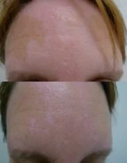 Vitiligo Treatment Cutis Dermatology Brisbane 17
