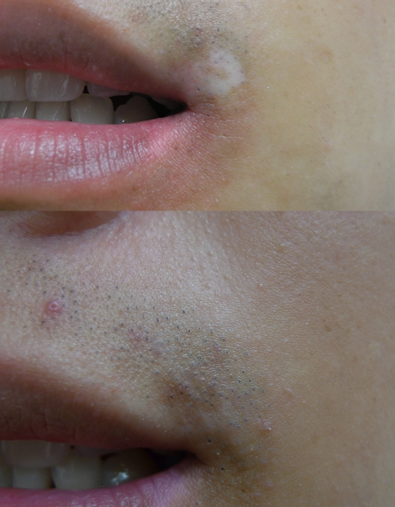 Vitiligo Treatment Cutis Dermatology Brisbane 19