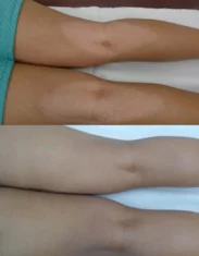 Vitiligo Treatment Cutis Dermatology Brisbane 20