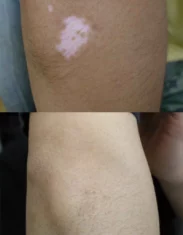 Vitiligo Treatment Cutis Dermatology Brisbane 21