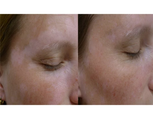 Vitiligo Treatment Cutis Dermatology Brisbane 4 1