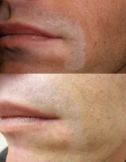 Vitiligo Treatment Cutis Dermatology Brisbane 5 1