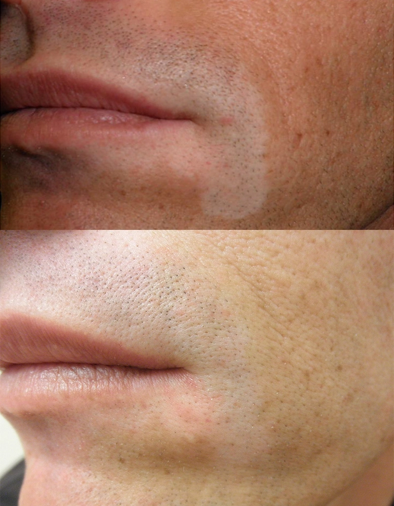 Vitiligo Treatment Cutis Dermatology Brisbane 5