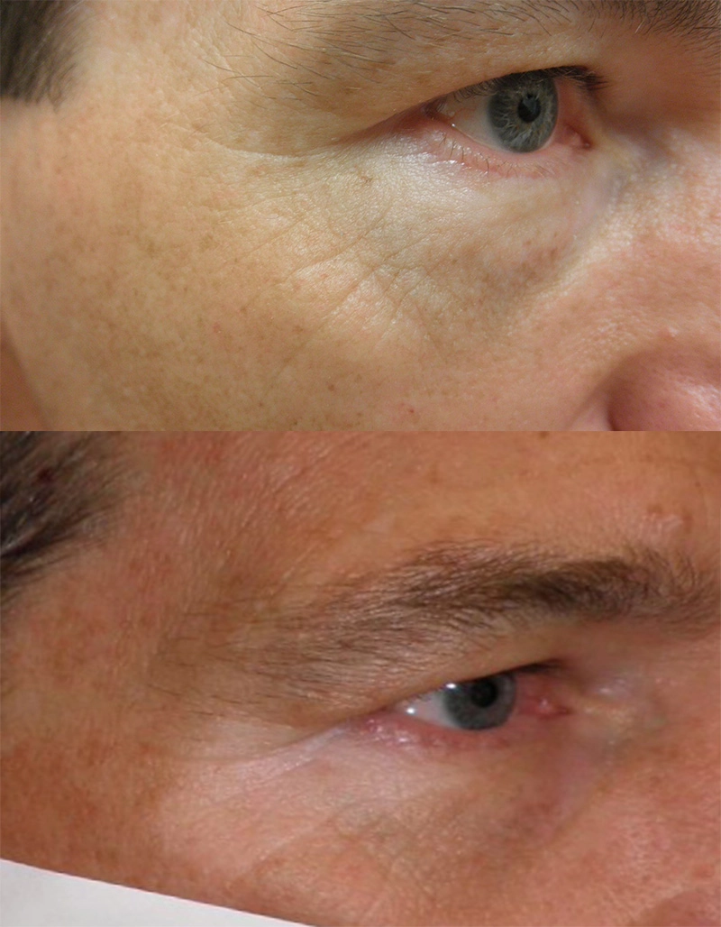 Vitiligo Treatment Cutis Dermatology Brisbane 6 1