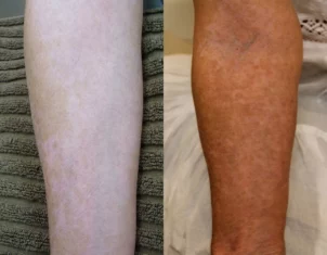 Vitiligo Treatment Cutis Dermatology Brisbane 7