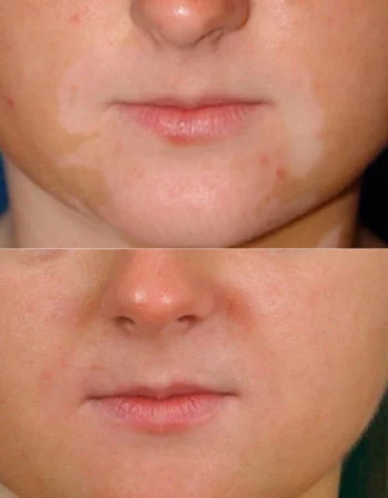 Vitiligo Treatment Cutis Dermatology Brisbane 9