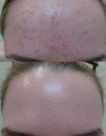 Acne Treatment Cutis Dermatology Brisbane 45