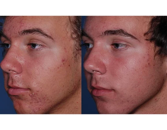 Acne Treatment Cutis Dermatology Brisbane 47