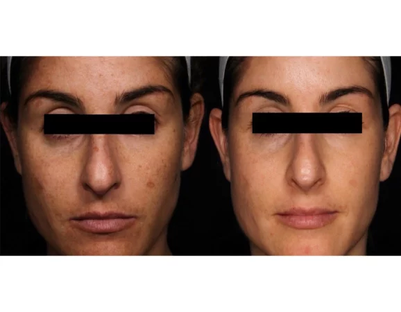 Acne Treatment Cutis Dermatology Brisbane 48