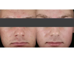 Acne Treatment Cutis Dermatology Brisbane 49