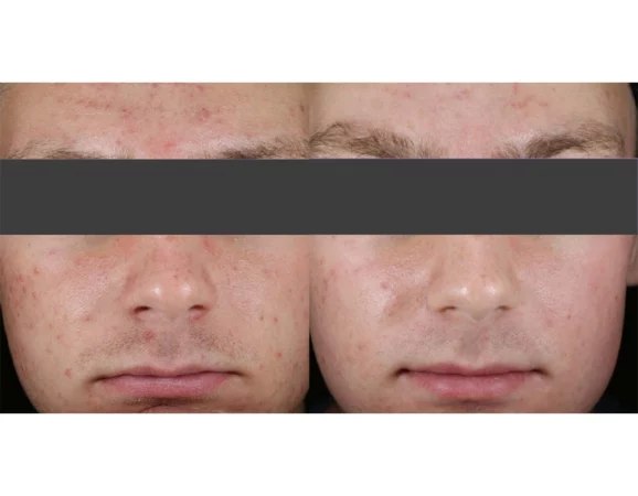 Acne Treatment Cutis Dermatology Brisbane 49