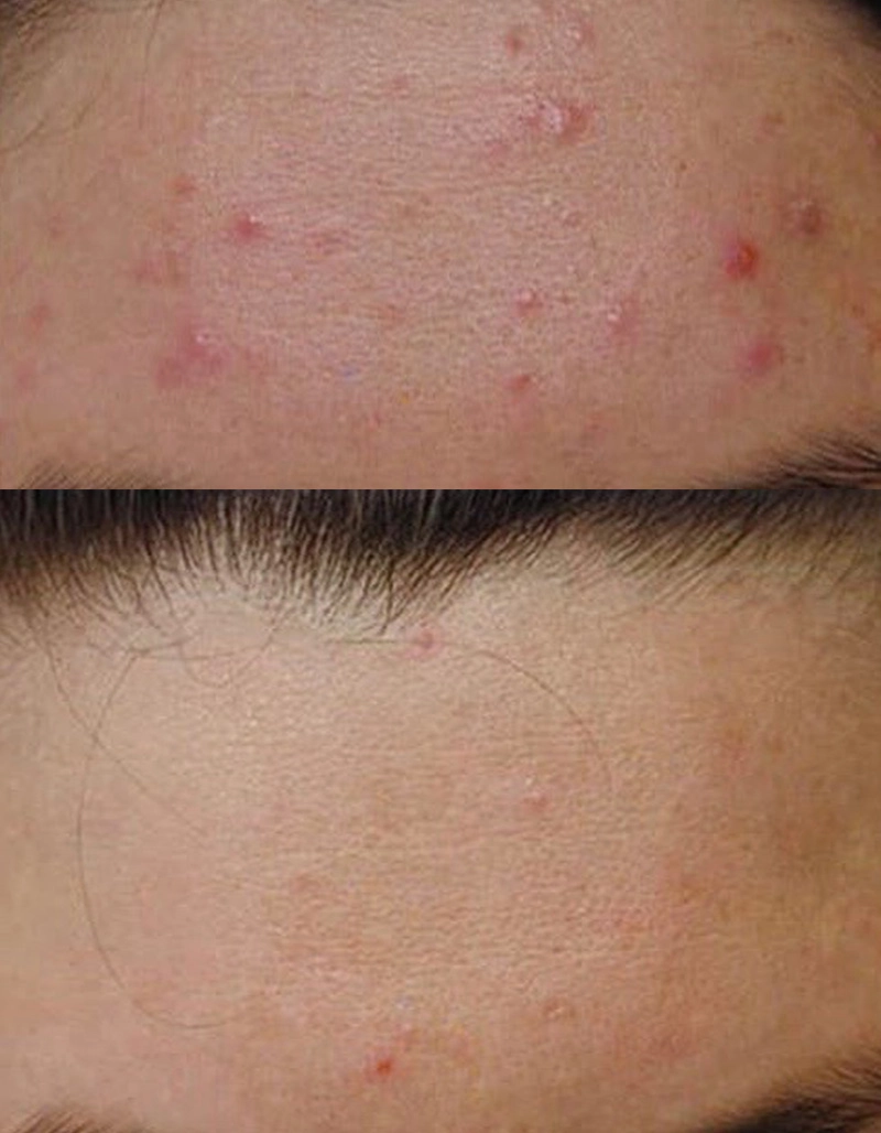 Acne Treatment Cutis Dermatology Brisbane 52