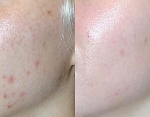 Acne Treatment Cutis Dermatology Brisbane 53 e1655810496129