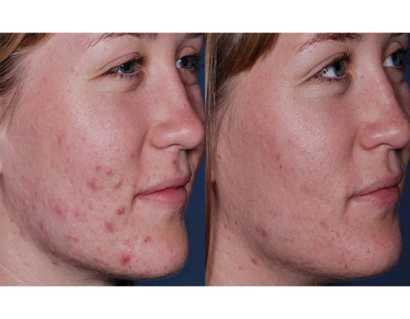 Acne Treatment Cutis Dermatology Brisbane 55