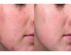 Acne Treatment Cutis Dermatology Brisbane 56