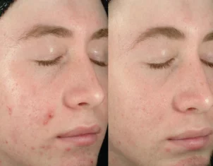 Acne Treatment Cutis Dermatology Brisbane 58