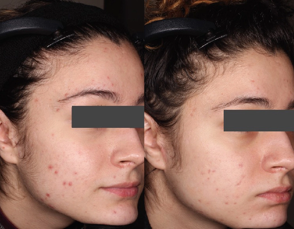 Acne Treatment Cutis Dermatology Brisbane 59