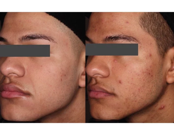Acne Treatment Cutis Dermatology Brisbane 60