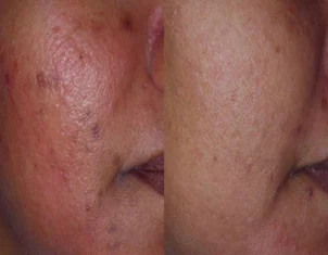 Acne Treatment Cutis Dermatology Brisbane 61