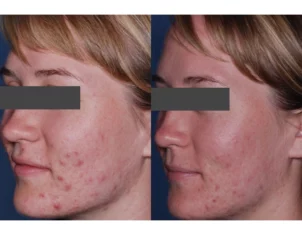 Acne Treatment Cutis Dermatology Brisbane 62